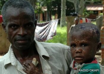 Kalehe : trois cas de Monkey-Pox confirmés dans la zone de santé de Minova