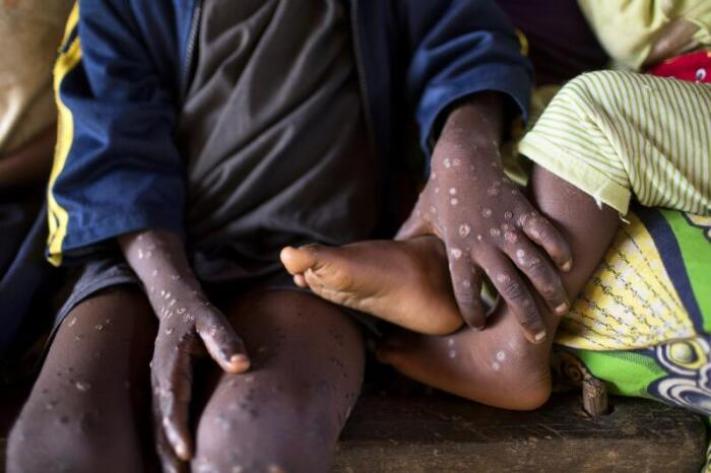 M-Pox : les autorités décident de renforcer la riposte