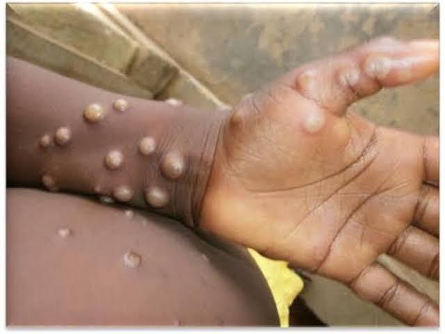 Sud-Kivu : près de 240 cas de variole du singe dont 3 décès enregistrés en 6 mois