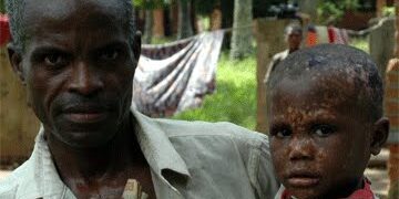 Kalehe : trois cas de Monkey-Pox confirmés dans la zone de santé de Minova